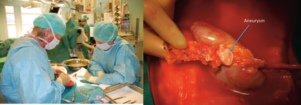 Figur 3. Extracorporal kirurgi på “bakbord”: Nitid preparering av nyren, med sikring av alle kar, er en forutsetning for implantasjon med minimal invasiv teknikk. Aneurysmet excideres. I dette tilfelle (kasus 1) lot det seg gjøre å bevare en felles arterie-stamme.